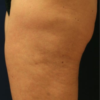 50 year old woman before and 8 mos. after ThermiTight of thighs for cellulite and loose skin before 2514569