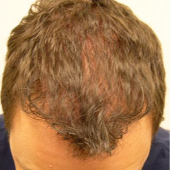 33 year old man treated with FUE Hair Transplant after 3564710