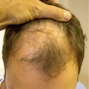 33 year old man treated with FUE Hair Transplant before 3564710