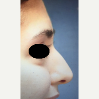 25-34 year old woman treated with Rhinoplasty before 3204871