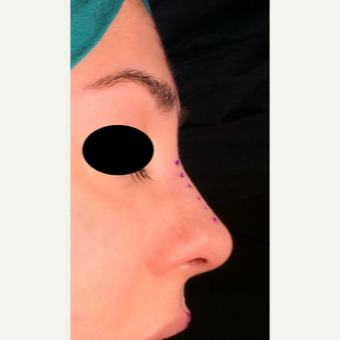 25-34 year old woman treated with Rhinoplasty after 3204871