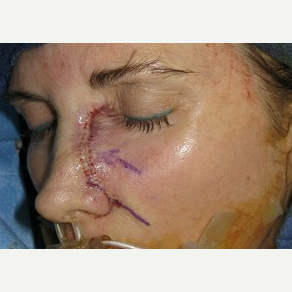 25-34 year old woman treated with Mohs Surgery before 3389212
