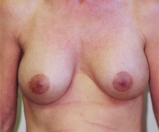 Female Breast Augmentation before 1302524