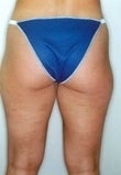 27 year old female patient before 928713