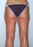 27 year old female patient after 928713