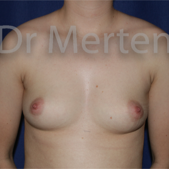 18-24 year old man treated with FTM Chest Masculinization Surgery before 3828910