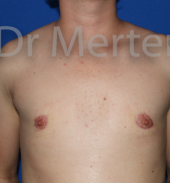 18-24 year old man treated with FTM Chest Masculinization Surgery after 3828910