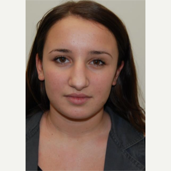 18-24 year old woman treated with Rhinoplasty before 3143535