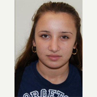 18-24 year old woman treated with Rhinoplasty after 3143535