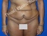 55-64 year old woman treated with Tummy Tuck before 1548816