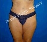 55-64 year old woman treated with Tummy Tuck after 1548816