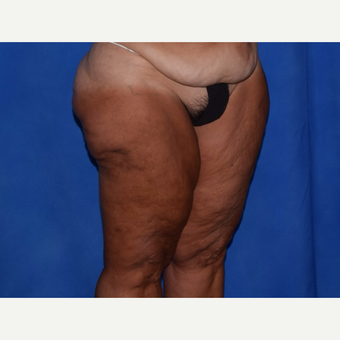45-54 year old woman treated with Thigh Lift before 3755285