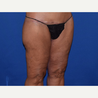 45-54 year old woman treated with Thigh Lift after 3755285
