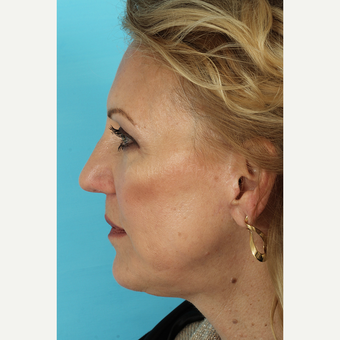 55-64 year old woman treated with Facelift after 3691416