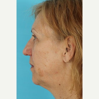55-64 year old woman treated with Facelift before 3691416