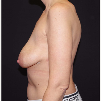 35-44 year old woman treated with Breast Implant Removal after 3741653