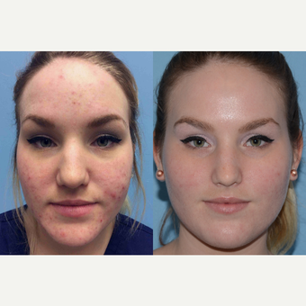 25-34 year old woman treated with Acne Treatment before 3246037