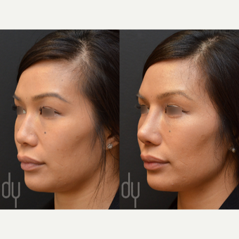 25-34 year old woman treated with Asian Rhinoplasty before 3477449