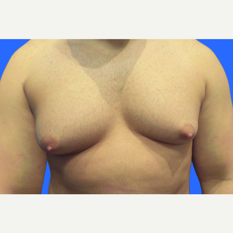 29 year old male, Gynecomastia before 3147091