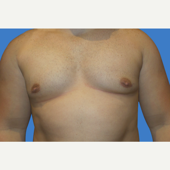 29 year old male, Gynecomastia after 3147091