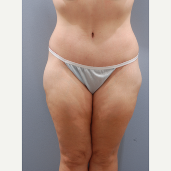 45-54 year old woman treated with Tummy Tuck after 3603911