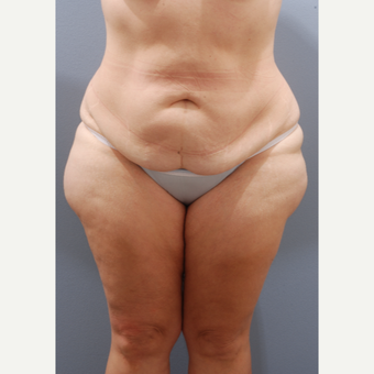 45-54 year old woman treated with Tummy Tuck before 3603911