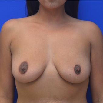 25-34 year old woman treated with Breast Augmentation before 3299285
