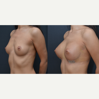 25-34 year old woman treated with Breast Implants before 3238798