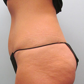 45 year old woman treated with Tummy Tuck after 3468450