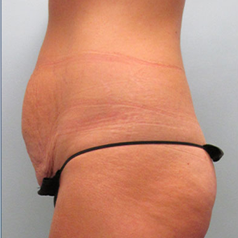 45 year old woman treated with Tummy Tuck before 3468450
