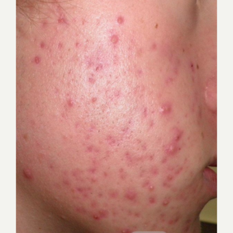 Acne before 3696945