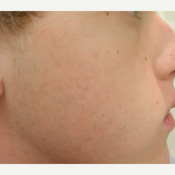 Acne after 3696945