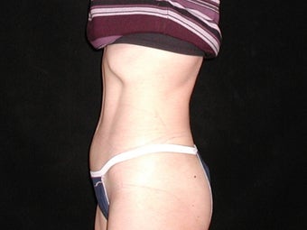 45 Year Old Female Mini Tummy Tuck after 892521