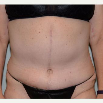 45-54 year old woman treated with Tummy Tuck after 3736617