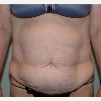45-54 year old woman treated with Tummy Tuck before 3736617