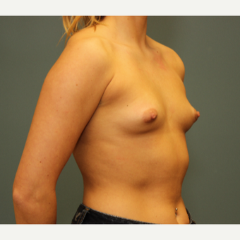 25-34 year old woman treated with Breast Augmentation before 3094483