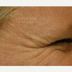 45-54 year old woman treated with Botox before 3458226