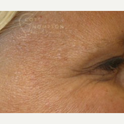 45-54 year old woman treated with Botox after 3458226