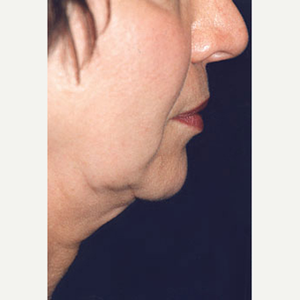 55-64 year old woman treated with Liposuction before 3646590