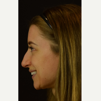 Tip Elevation to Prevent Droopy Nose when Smiling before 3523843