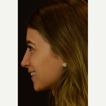 Tip Elevation to Prevent Droopy Nose when Smiling after 3523843