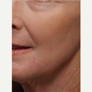 45-54 year old woman treated with Chemical Peel after 3646210