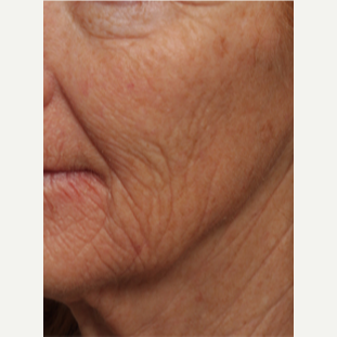 45-54 year old woman treated with Chemical Peel before 3646210