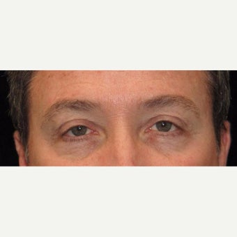 48 Year Old Man with Upper Eyelid Surgery (Blepharoplasty) before 2284889
