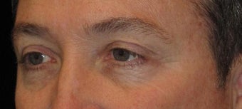 48 Year Old Man with Upper Eyelid Surgery (Blepharoplasty) 2284889