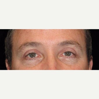 48 Year Old Man with Upper Eyelid Surgery (Blepharoplasty) after 2284889