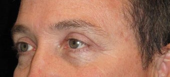 48 Year Old Man with Upper Eyelid Surgery (Blepharoplasty) 2284889