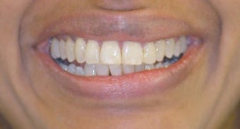 Adult Orthodontics with Clear Braces after 3659960