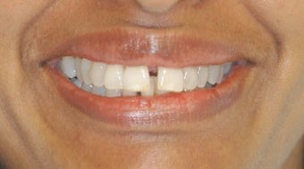 Adult Orthodontics with Clear Braces before 3659960