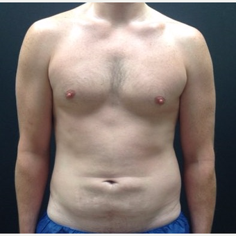 35-44 year old man treated with Male Tummy Tuck before 3768858